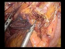 Embedded thumbnail for Dr Hauters - Exérèse d&amp;quot;une mucocèle appendiculaire 