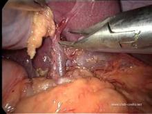 Embedded thumbnail for Dr Siriser - Splénectomie partielle par laparoscopie